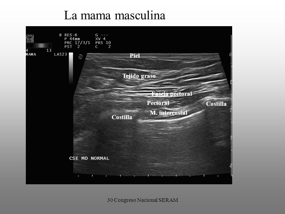 carcinoma de prostata seram